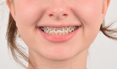 Создаем улыбки. Брекеты